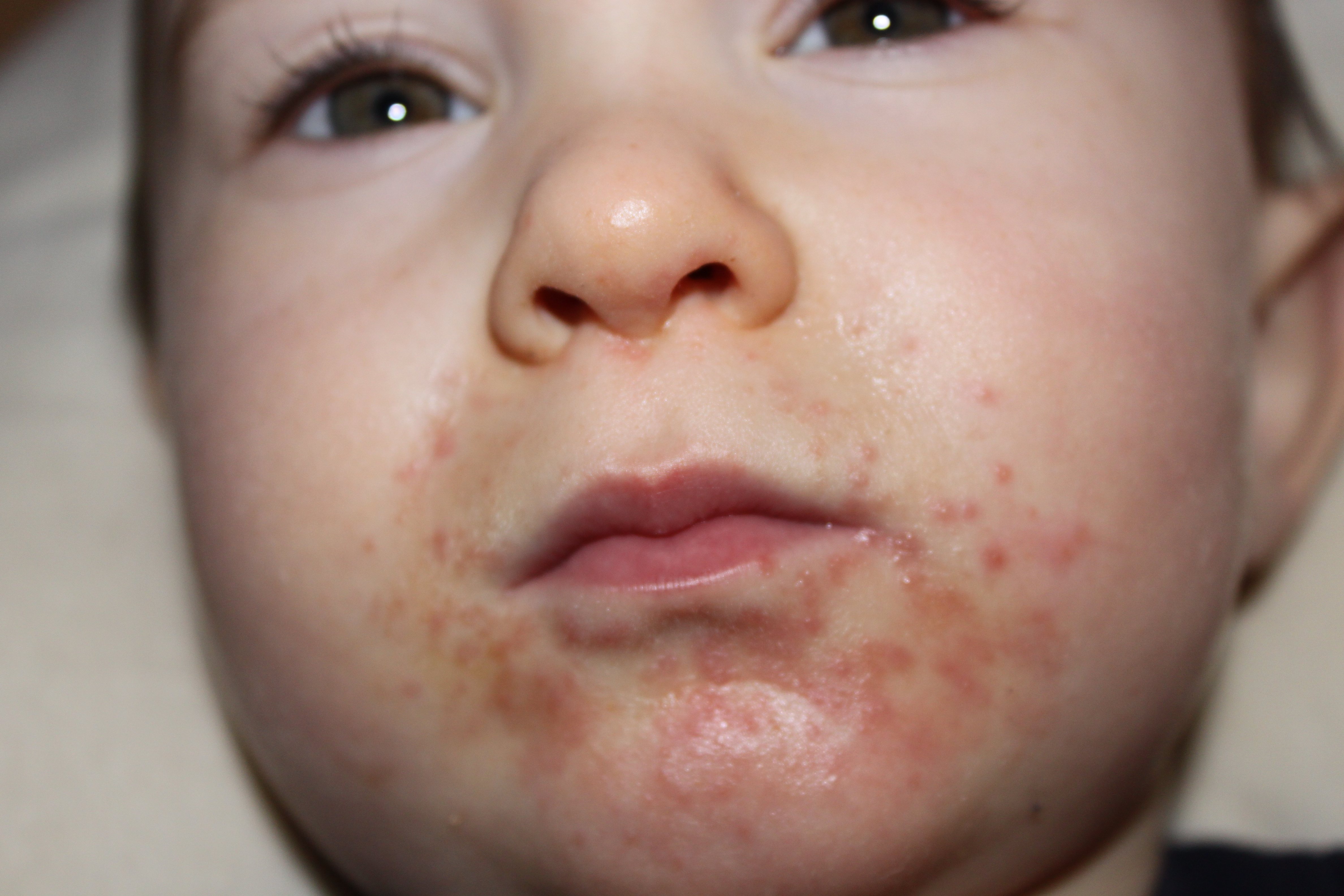 Small Rash On Face