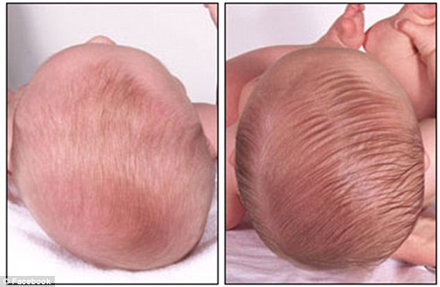 infant head flat on one side
